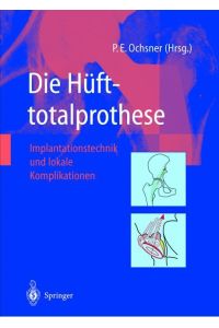 Die Hüfttotalprothese: Implantationstechnik und Lokale Komplikationen (German Edition) [Paperback] Ochsner, Peter E.