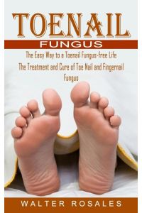 Toenail Fungus  - The Easy Way to a Toenail Fungus-free Life (The Treatment and Cure of Toe Nail and Fingernail Fungus)