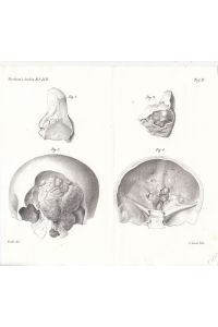 Osteome der Stirnhöhle. Lithographie von Laue nach Veith, 21 x 23 x cm, aus: Virchows Arch. path. Anat. , 1873.