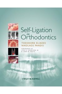 Self-Ligation in Orthodontics: An Evidence-Based Approach to Biomechanics and Treatment