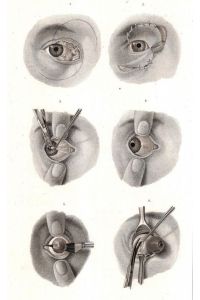 Operative Tafel XVIII. Operationen an den Augenlidern und dem Augapfel