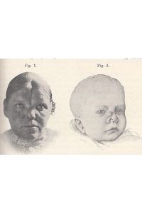 Zur Kenntnis der seitlichen Nasenspalten. IN: Beiträge zur klinischen Chirurgie, Bd. 65, S. 54-61, 2 Abbildungen, 1909, Br.