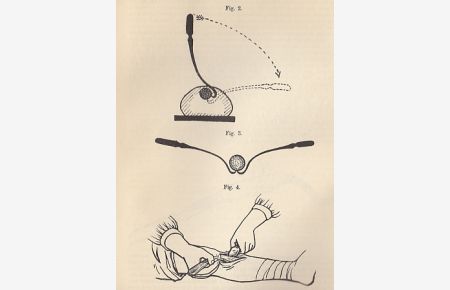 Knochenhebel für Osteotomien. IN: Zbl. Chir. , 33/33, S. 900-903, 4 Fig. , 1906, Br.